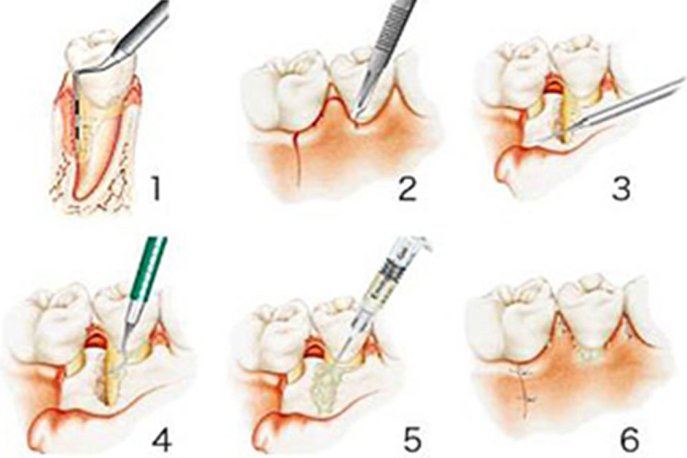 歯周組織再生療法
