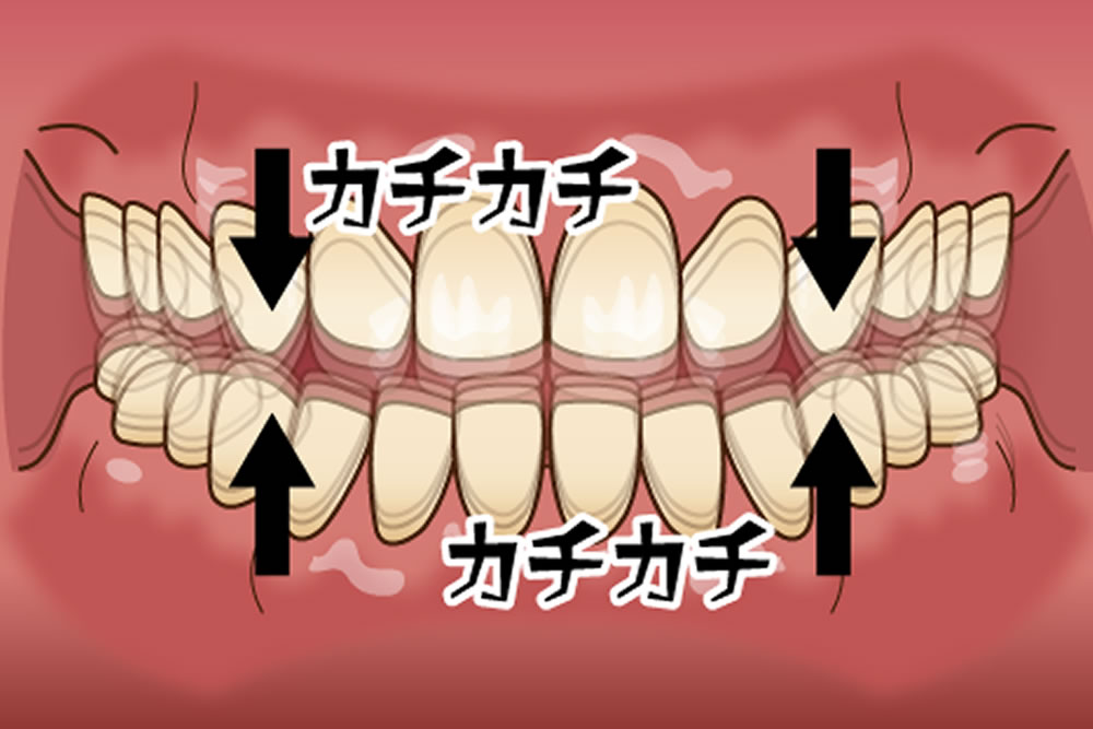 タッピング