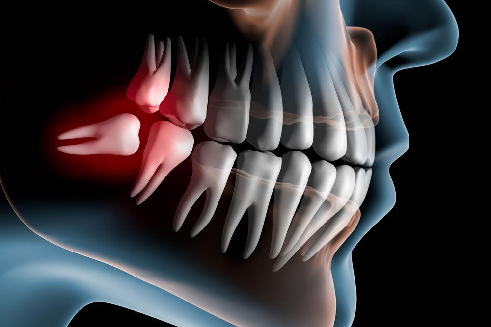 親知らずの抜歯に伴うリスク