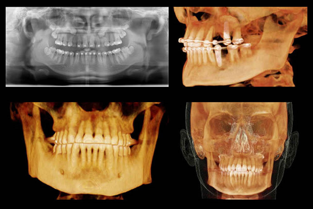 歯科用CTによる精密検査を実施
